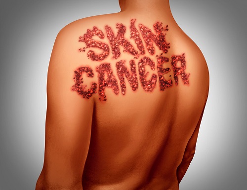 אבחון סרטן העור