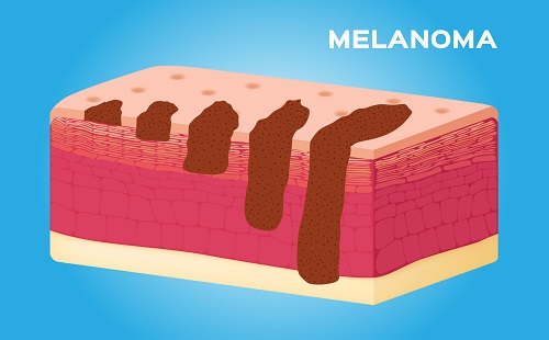 62948088 - illustration of the growth of melanoma
